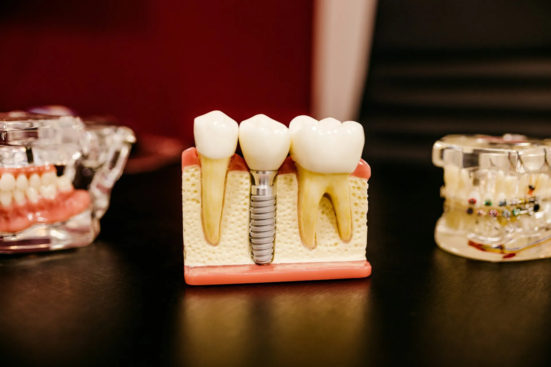 Dental implant model used to explain treatment